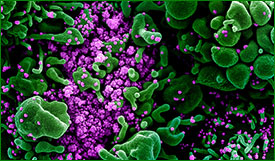image of apoptotic cell (green) heavily infected with SARS-COV-2 virus particles (purple)