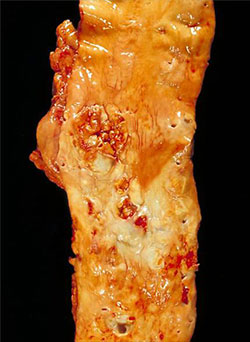 An image of the aorta showing extensive atherosclerosis of its walls. 