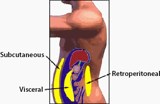 An illustration of subcutaneous and intra-abdominal fst.