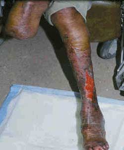 Poorly Healing Leg Ulcer in Patient with Previous Amputation A photograph of a man's leg showing a poorly healing leg ulcer.