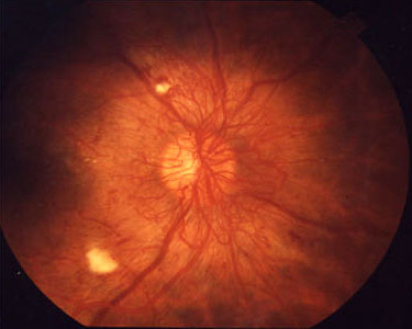 A funduscopic view of the optic disc of a person with diabetic retinopathy. 