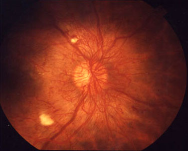 Neovascularization of the Retina A funduscopic view of the optic disc of a person with diabetic retinopathy.