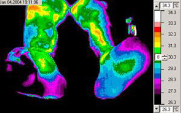 Impaired Peripheral Perfusion in Diabetic Foot A thermal image showing impaired peripheral perfusion in diabetic foot.