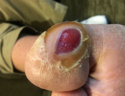 Photo of Diabetic Foot Ulcer