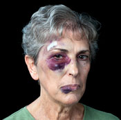Battered Woman photo of battered woman