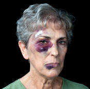 photo of battered woman