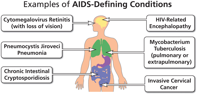 Graphic Showing Examples of AIDS-Defining Conditions