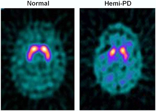 I-FP-CIT SPECT images of healthy volunteer and patient with early hemi-PD