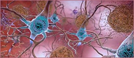 Image: Dying Nerve Cell Showing Connections Weakening
