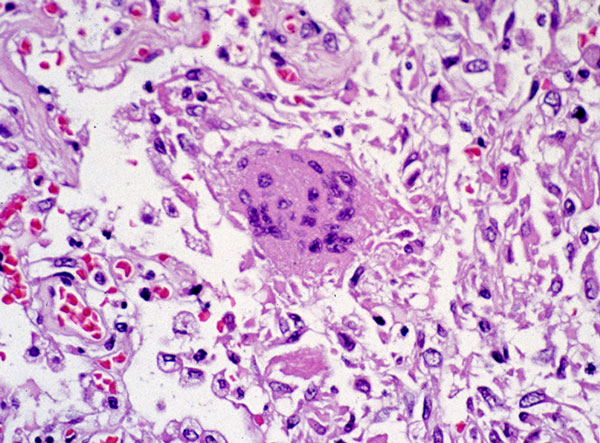 Photomicrograph of Lung Tissue Pathology Due to SARS Photomicrograph of Lung Tissue Pathology Due to SARS
