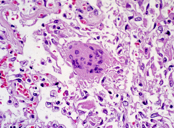 Photomicrograph of Lung Tissue Pathology Due to SARS