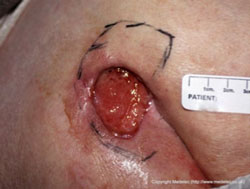 Photo of Stage 3 Full Thickness Wound