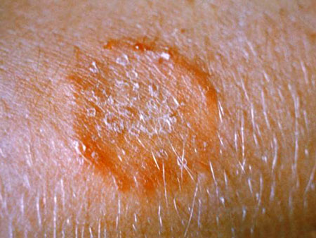Photo: Ringworm Infection on the Arm