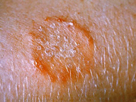 Photo: Ringworm Infection on the Arm Photo: Ringworm Infection on the Arm