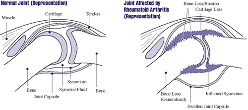 Normal joint and joint affected by rheumatoid arthritis