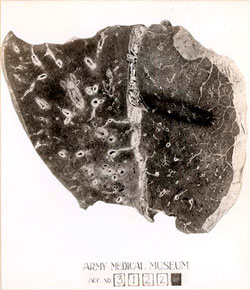 Lung Tissue from Influenza Patient Photo of Lung from Flu Patient