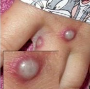 Photo of a monkeypox lesion on a person's hand.