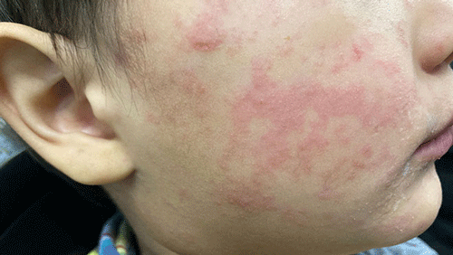 Child With Measles Rash