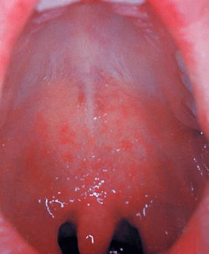 Photo of Kopik Spots on Palate