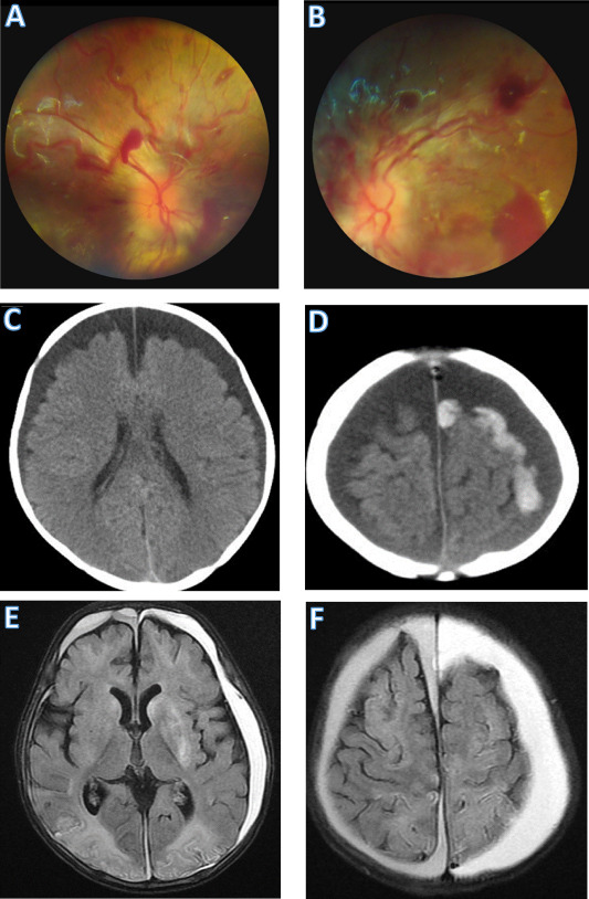 Graphic: Abusive Head Injury in an Infant