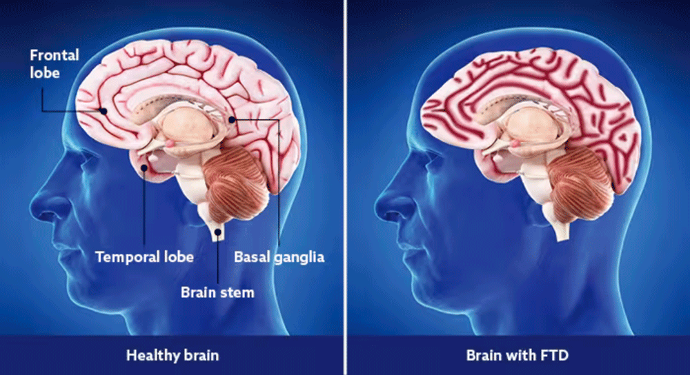 Image: Frontal and Temporal Lobes of the Brain—Normal Brain and Brain with FTD