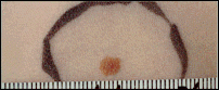 A common mole that is round with a distinct edge