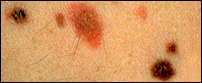 Dysplastic nevi that are a mixture of tan, brown, and red/pink