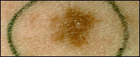 dysplastic nevus with an irregular edge and the color fading into the skin around it