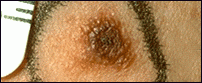 Dysplastic nevus with scaly or pebbly surfaces