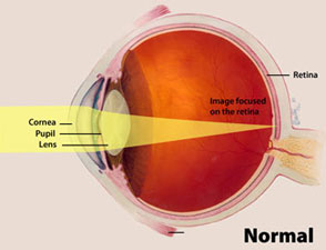 Illustration showing how normal eye focuses