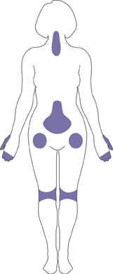 A body chart showing common locations of osteoarthritis.