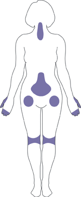 Osteoarthritis in Joints Drawing of areas affected by osteroarthritis.
