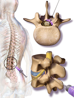 An illustration of steroids being injected into the cerebrospinal fluid in the canal surrounding the spine.