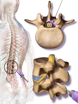 A drawing of an epidural steroid injection.