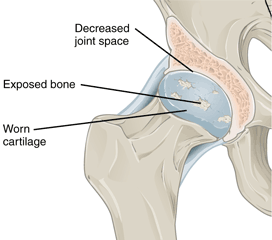Hip Joint Showing Osteoarthritis Progression Drawing of a osteroarthritic hip joint.