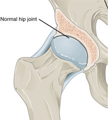 An illustration of a normal hip joint.