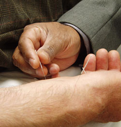 Application of acupuncture needle.