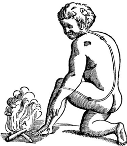 A 1664 illustration of pain pathway by René Descartes.