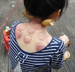 A photograph of a woman receiving cupping treatment on her upper back.