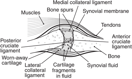 Osteoarthritic Knee Joint Showing Spurs A drawing of a knee joint with osteoarthritic bone spurs.