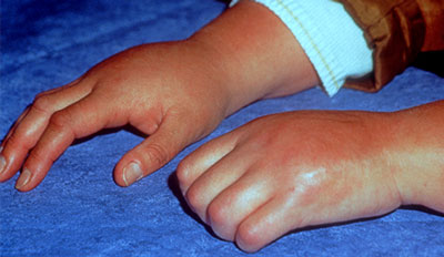 A photograph of a person with complex regional pain syndrome in both hands.