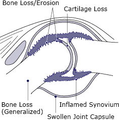 A drawing of a joint affected by rheumatoid arthritis.