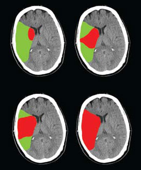 illustration of damaged and at risk tissue (penumbra) after an ischemic stroke illustration of damaged and at risk tissue (penumbra) after an ischemic stroke