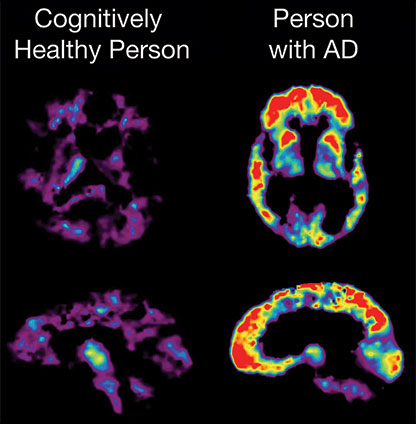 PET scan of healthy brain vs. person with Alzheimer's.