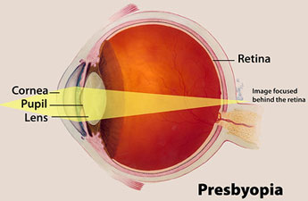 Illustration showing focus of eye with presbyopia