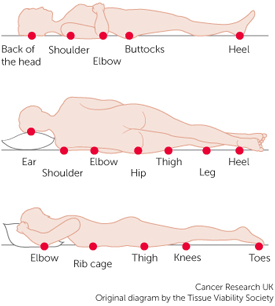 Illustration Showing Pressure Injury Points on the Human Body