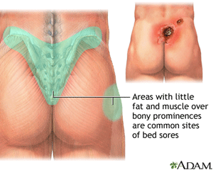 Illustration of an Area where Pressure Ulcers are Common