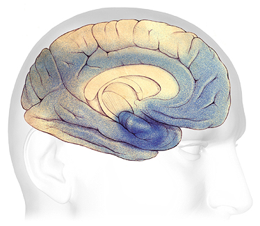 A drawing showing the formation of plaques and tangles in severe dementia.