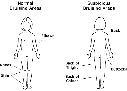 Evaluating Bruising Areas A drawing showing common and suspicious areas of bruising.