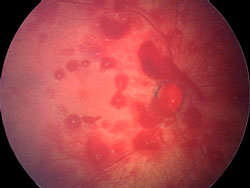 A scan showing a retinal hemorrhage.